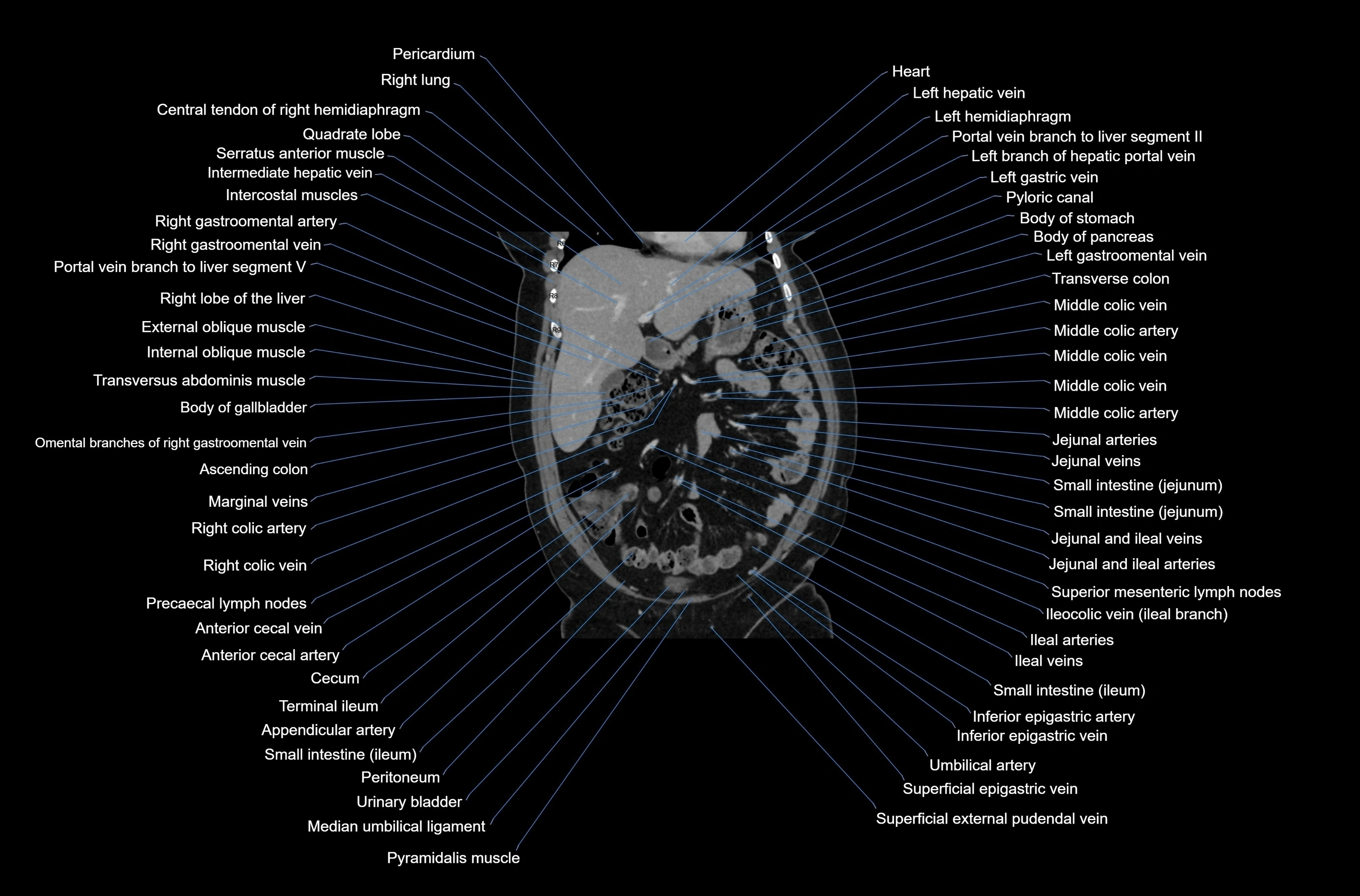 CT abdomen coronal cross sectional anatomy labelled radiology image-00028.webp